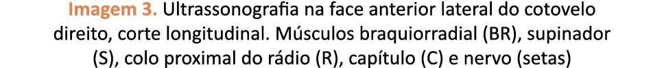 Imagem 3. Ultrassonografia na face anterior lateral do cotovelo direito, corte longitudinal. M sculos braquiorradial ...